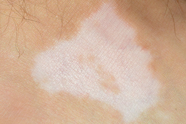 psoriasis-white-patches-what-happens-to-your-skin-during-a-flare-up