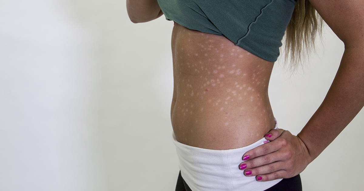 Facts About Psoriasis 11 Things You Might Not Know About Psoriasis